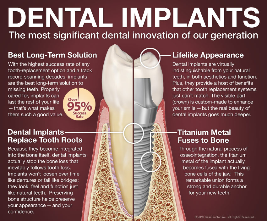 Dental Implants in Sequim, WA
